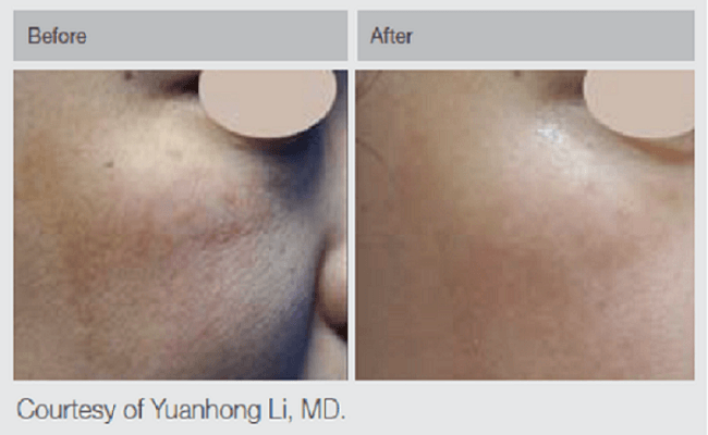 Tattoo Removal via Laser Therapy