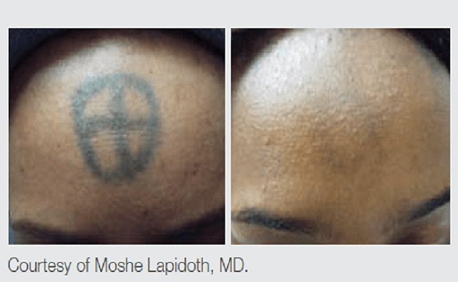 Tattoo Removal via Laser Therapy