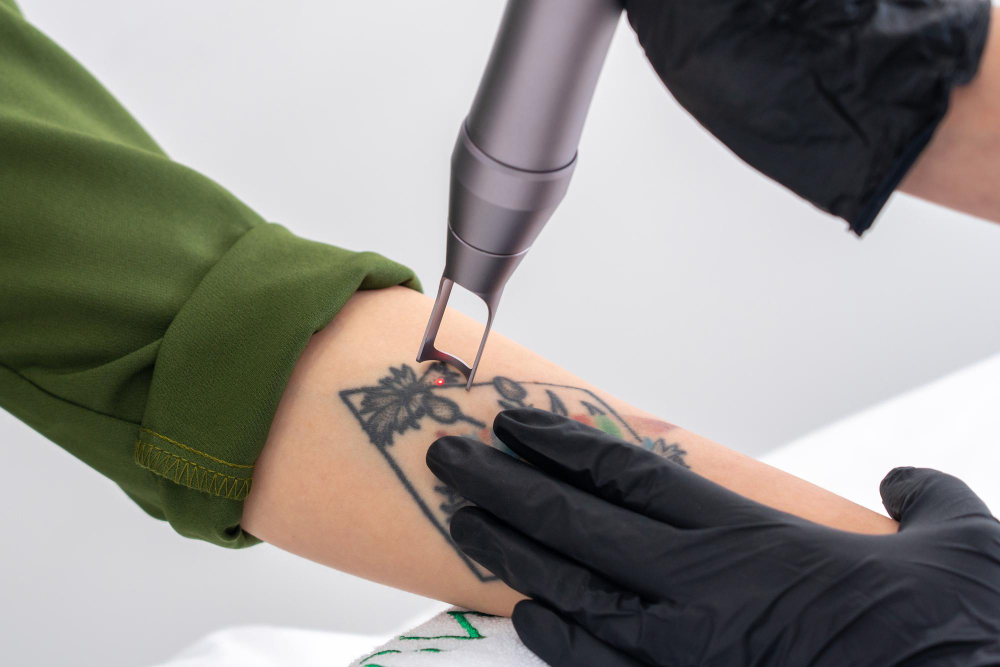 Tattoo Removal via Laser Therapy
