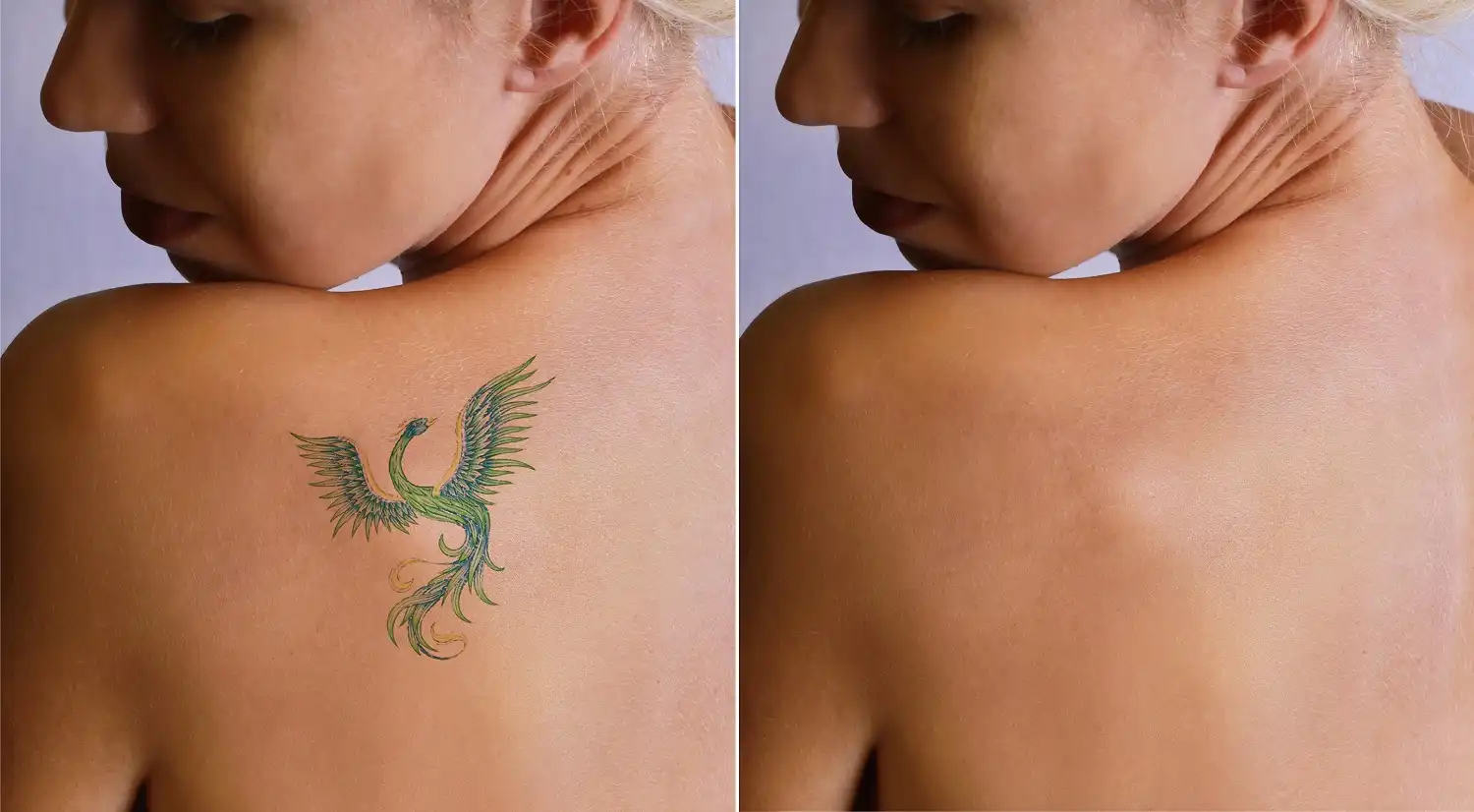 Laser Tattoo Removal in Monmouth County, NJ: What to Know Before Summer