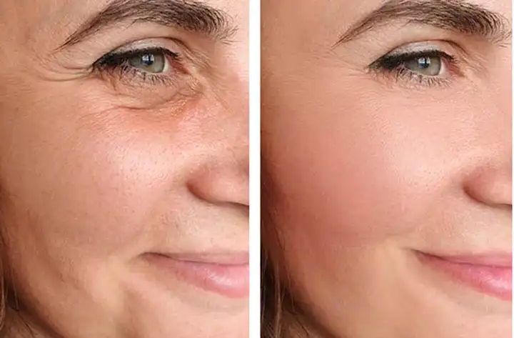 Non-Surgical Facelift Options: Lifting and Tightening Without Surgery